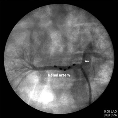 renal-artery-angiogram